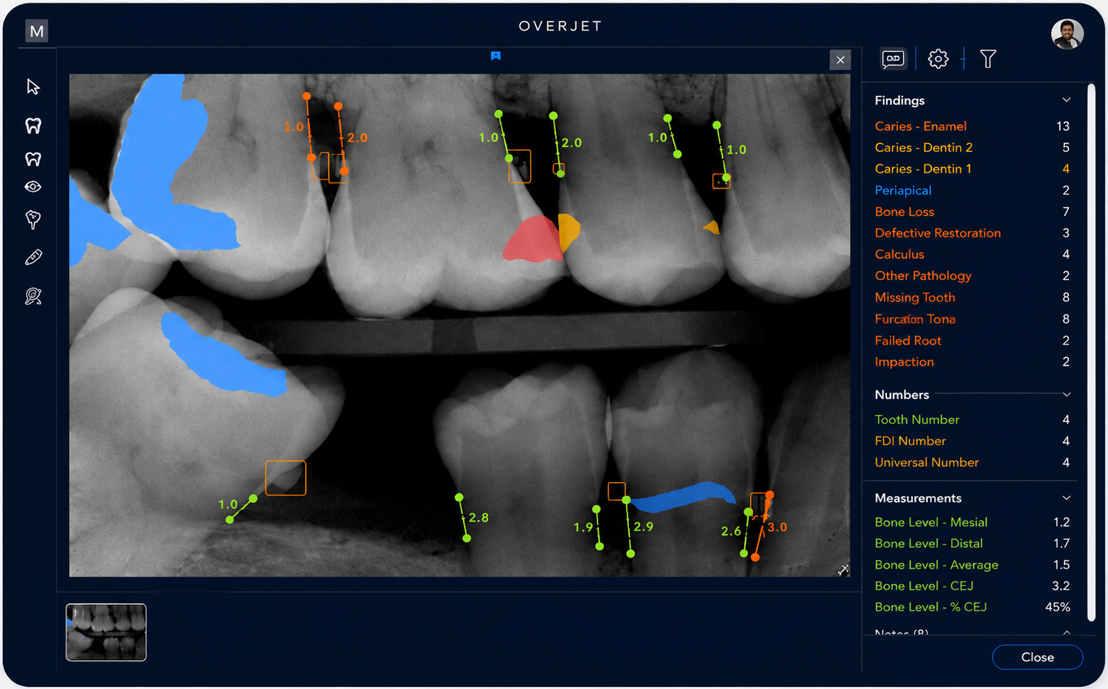 Overjet AI radiograph analysis